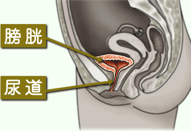 膀胱炎