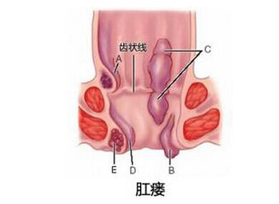 肛瘘